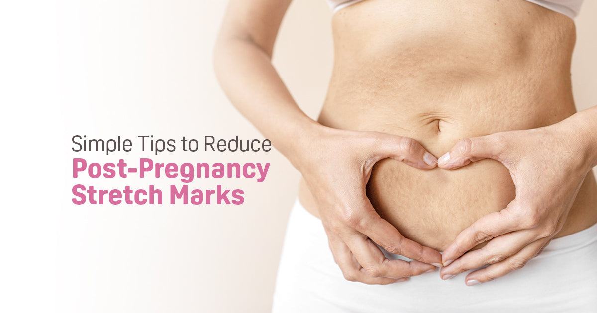 Simple Tips to Reduce Post-Pregnancy Stretch Marks